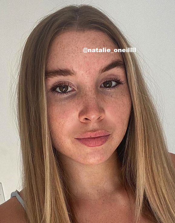 How does retinol get rid of freckles and hyperpigmentation?