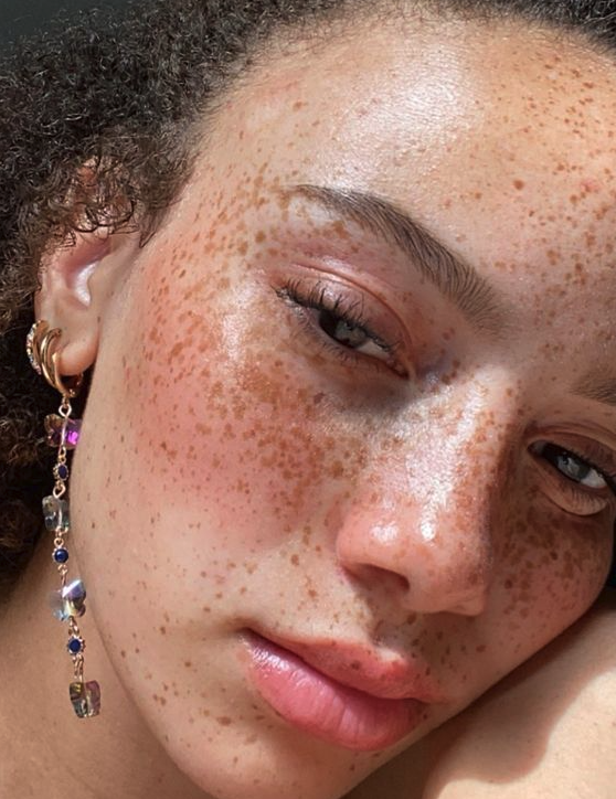 Not all freckles fade the same