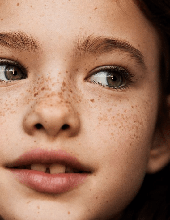 do freckles fade with age?