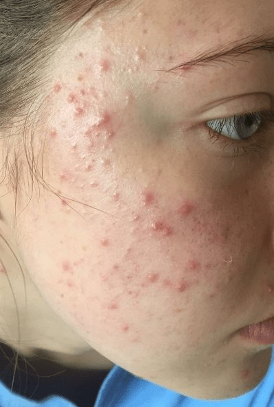 Best skincare for teen acne Best skincare for teen acne