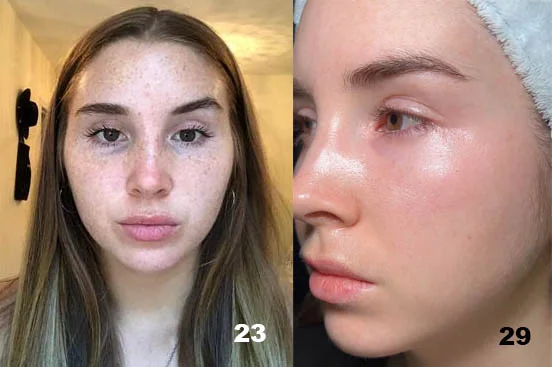 Does Retinol Get Rid of Freckles? Before and After