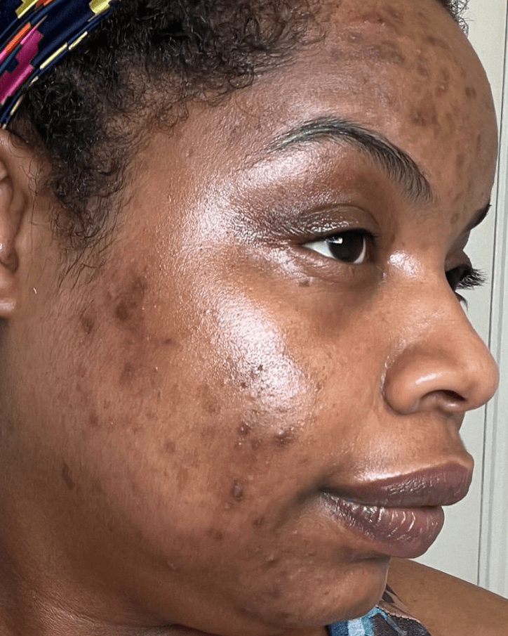 Differin purge vs Cerave resurfacing retinol purge