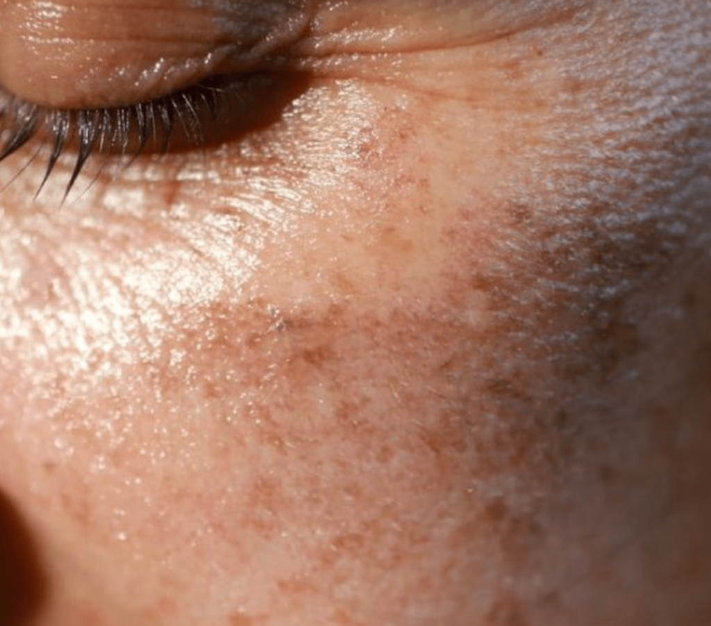 Sun damage