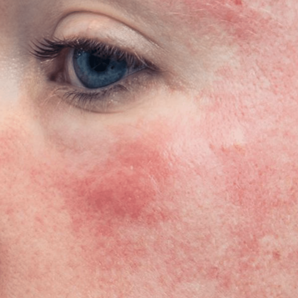 When to increase retinol strength