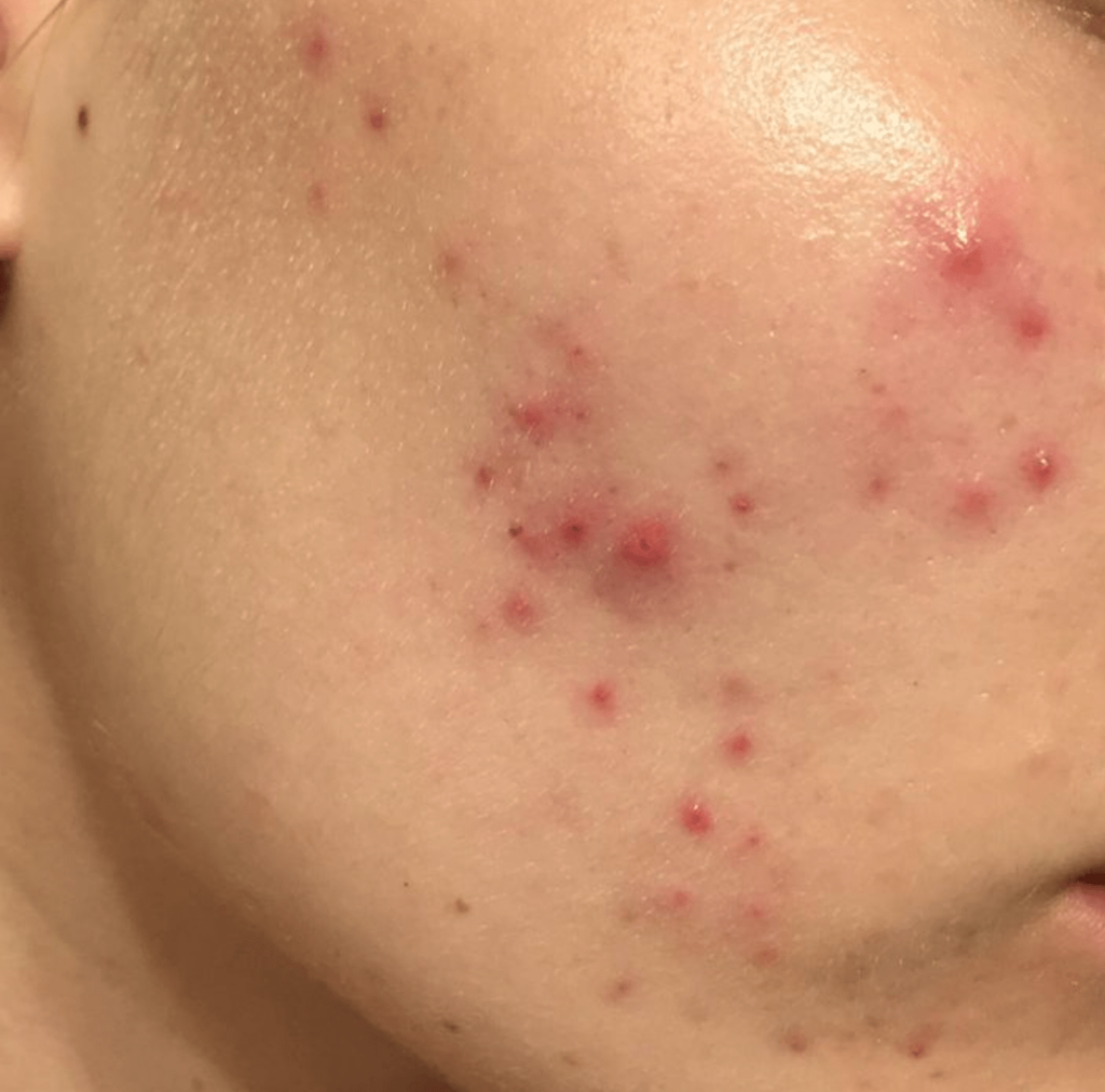 Does increasing retinol strength cause purging?