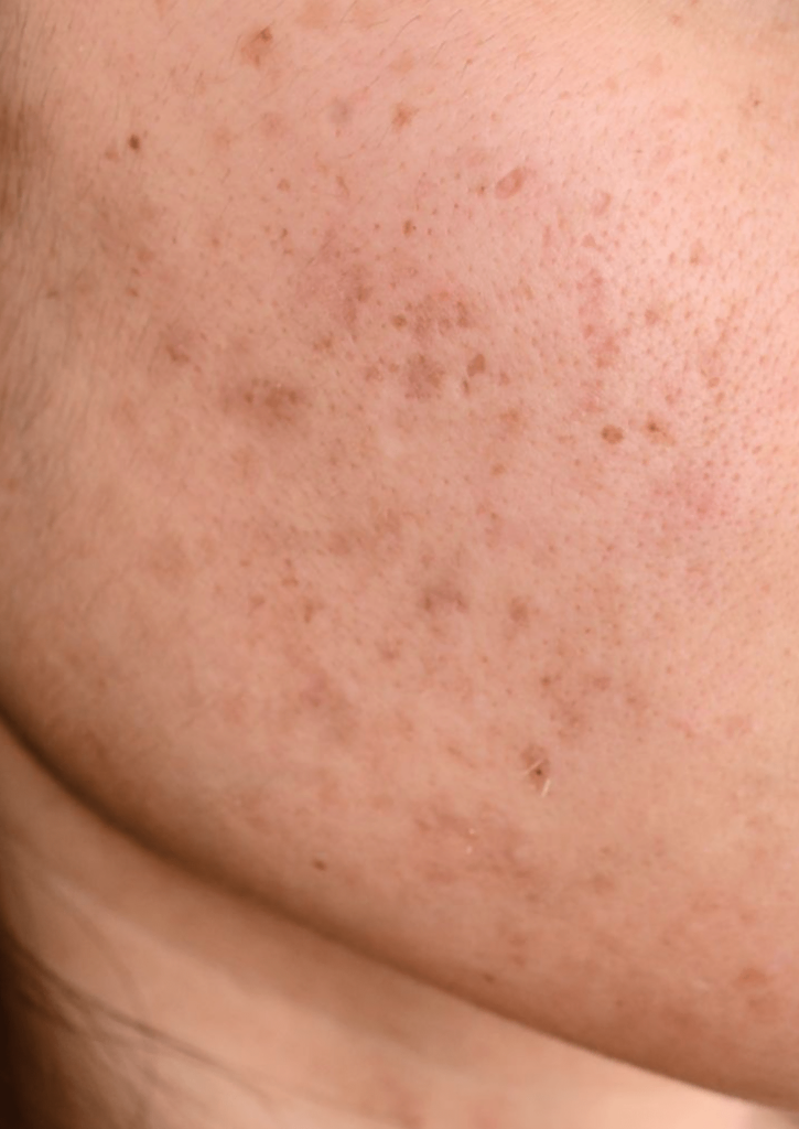 best korean skincare for acne scars, hyperpigmentation, PIE and PIH