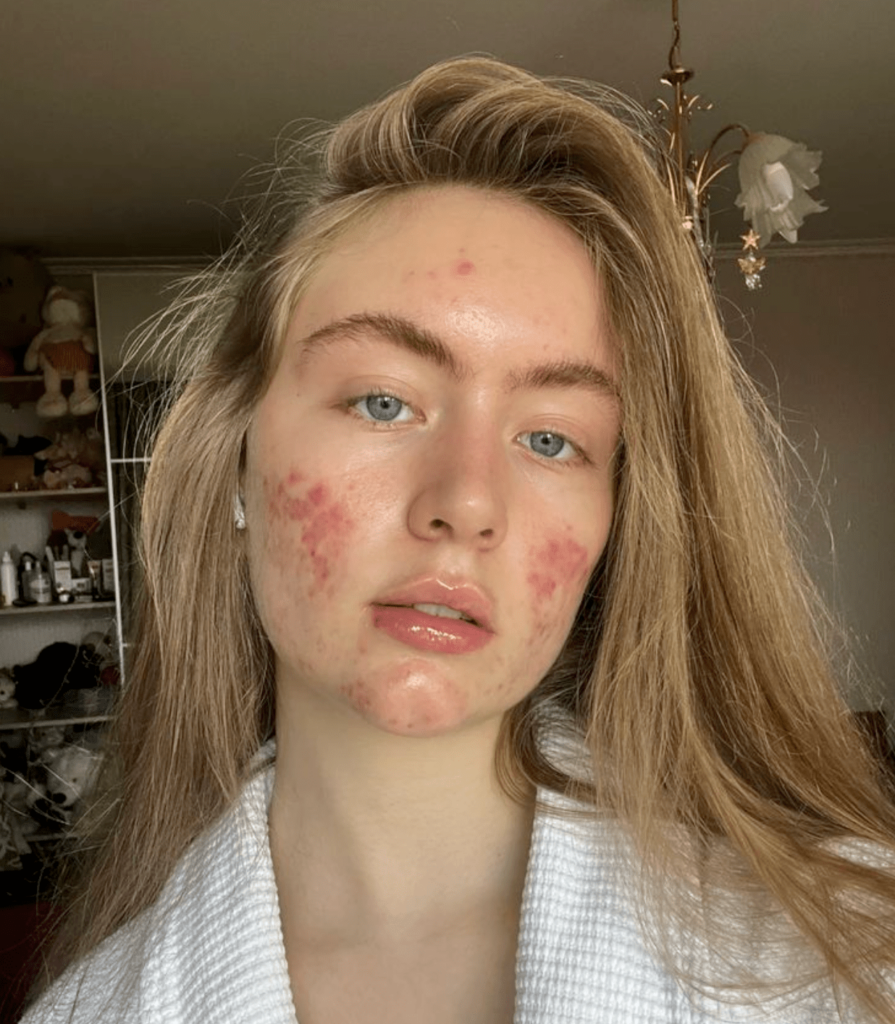 acne not going away