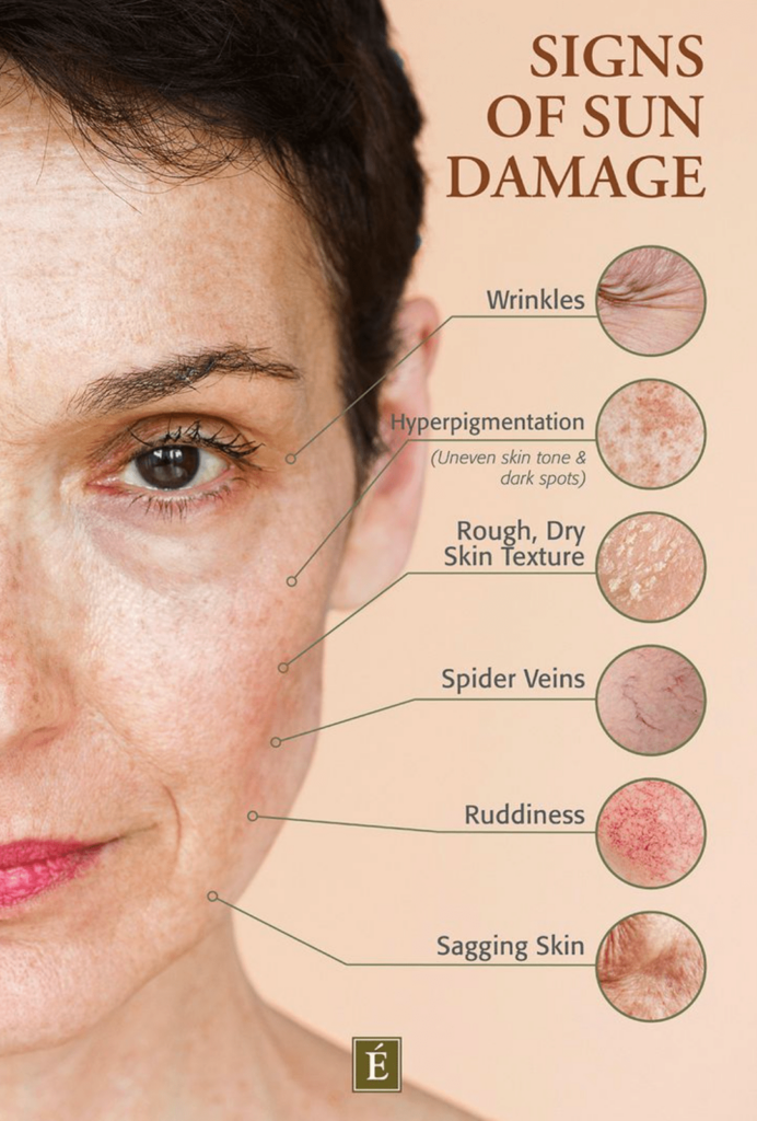sun damage signs Should I wear sunscreen everyday even in winter?