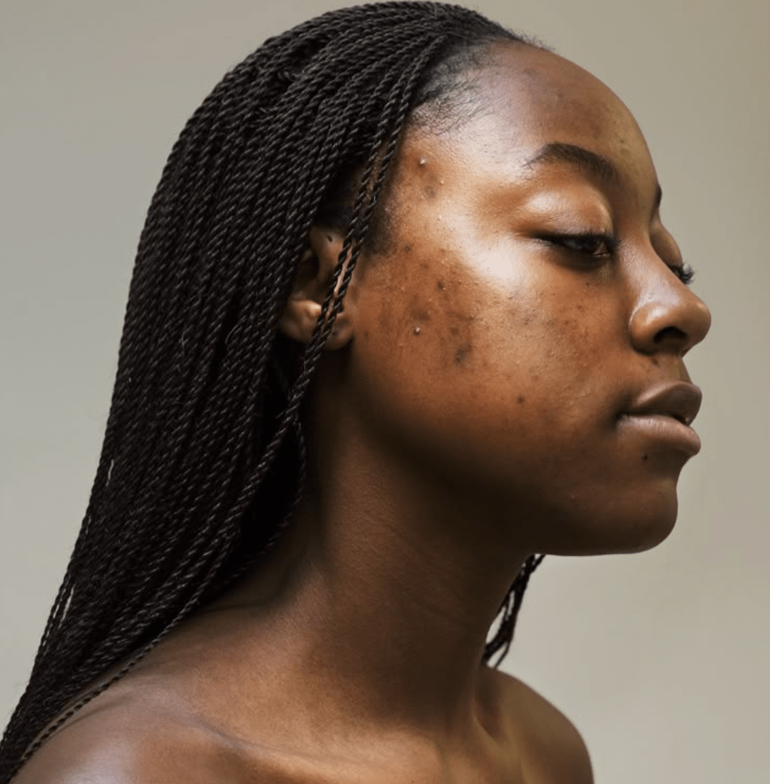 non comedogenic sunscreen Is non comedogenic sunscreen good for acne?