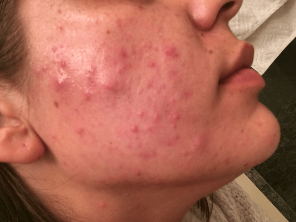 What does PCOS acne look like What does PCOS acne look like?