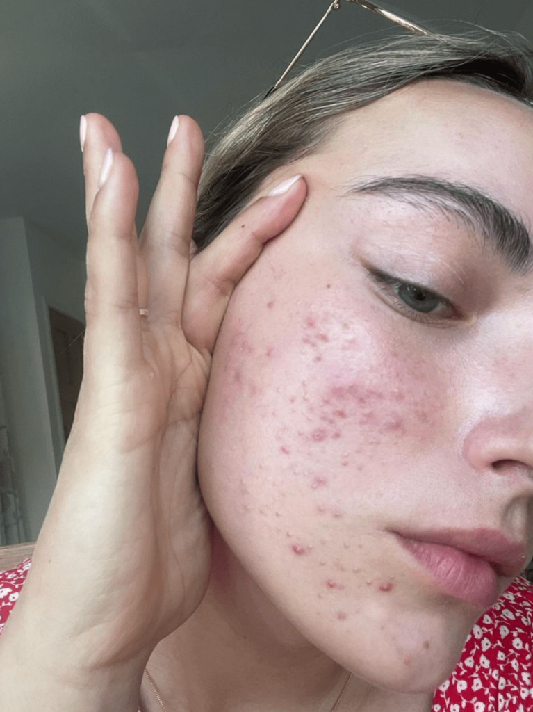 PCOS acne How to treat PCOS acne