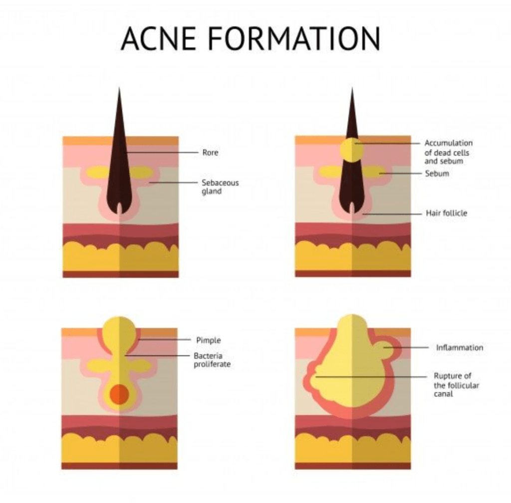 acne formation acne formation