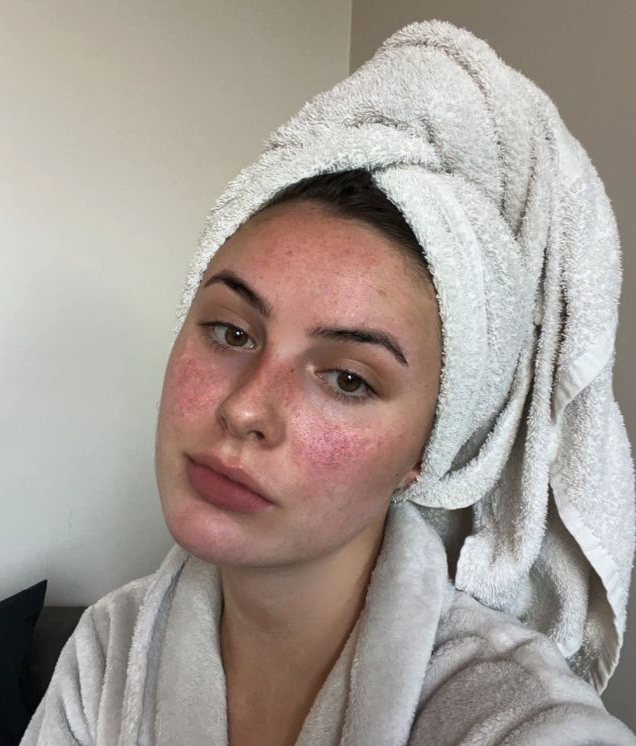 inflammation on skin inflammation on skin