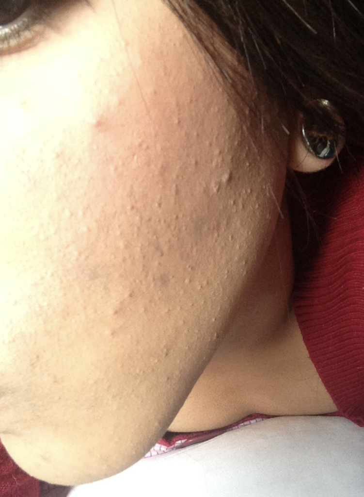 What is comedonal acne What is comedonal acne?