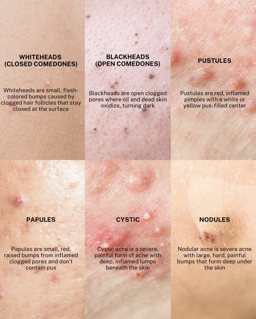 What does comedonal acne look like What does comedonal acne look like?