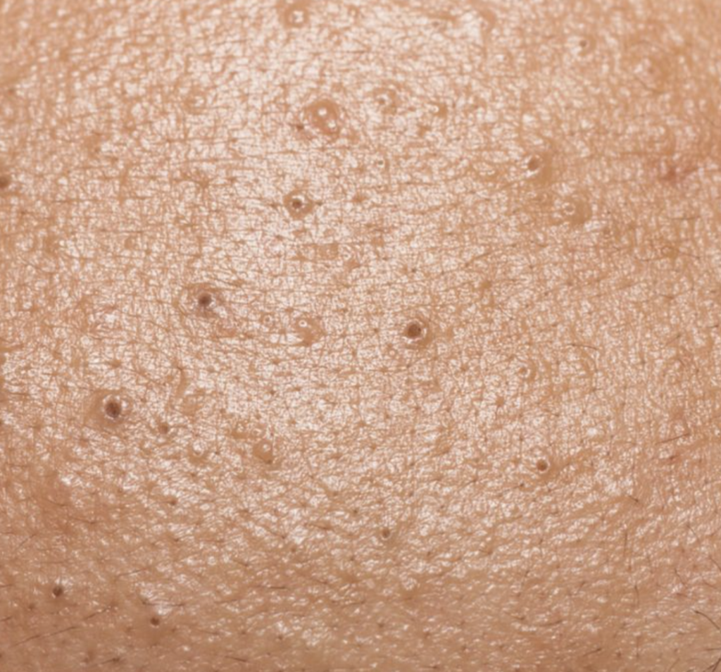 blackheads blackheads