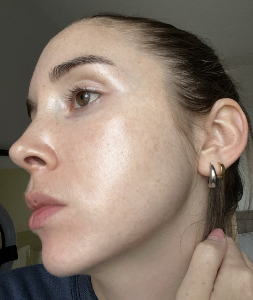 tips to get rid of comedonal acne How to get rid of comedonal acne