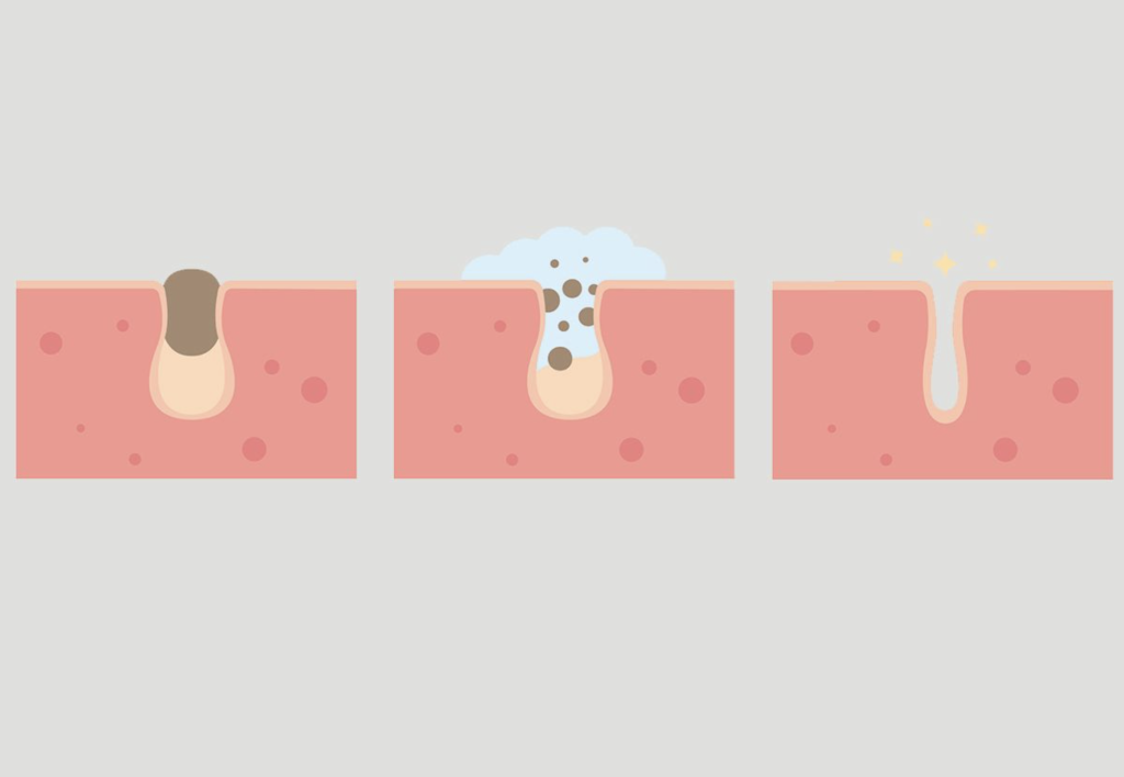 clogged pores graphic clogged pores graphic