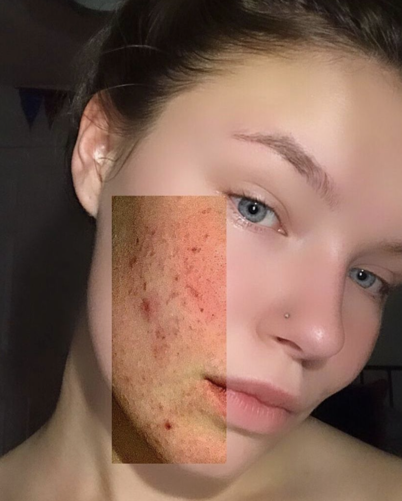 PCOS acne and regular acne PCOS acne vs. regular acne