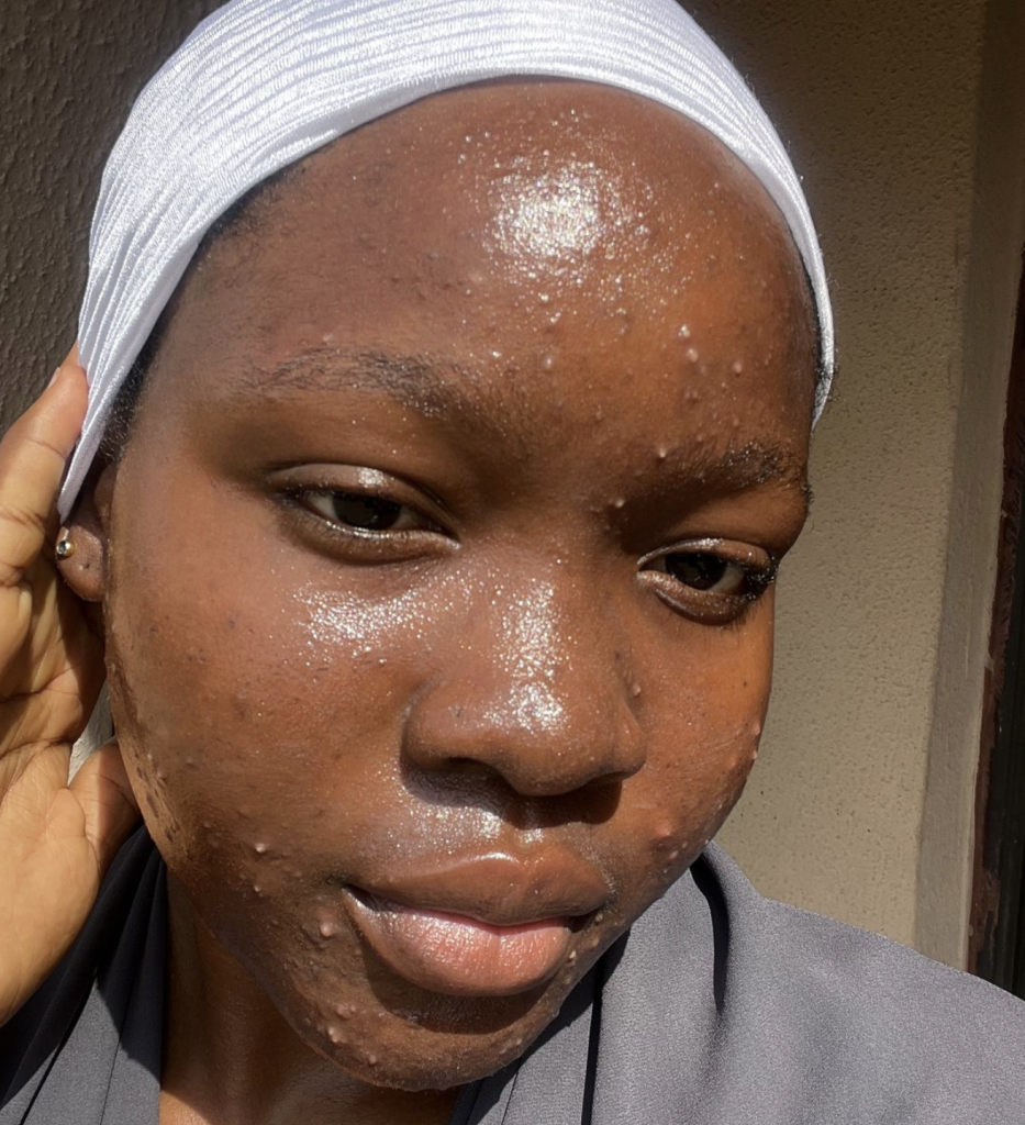 What is regular acne What is regular acne?