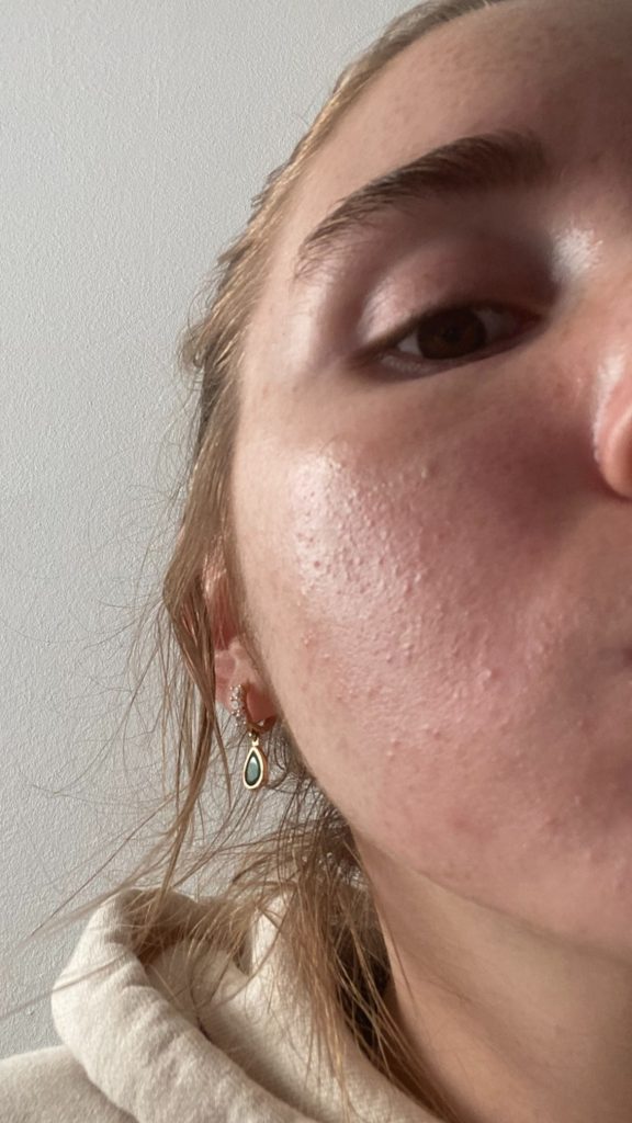 A Kiehl's moisturiser did this to my ski A Kiehl's moisturiser did this to my skin