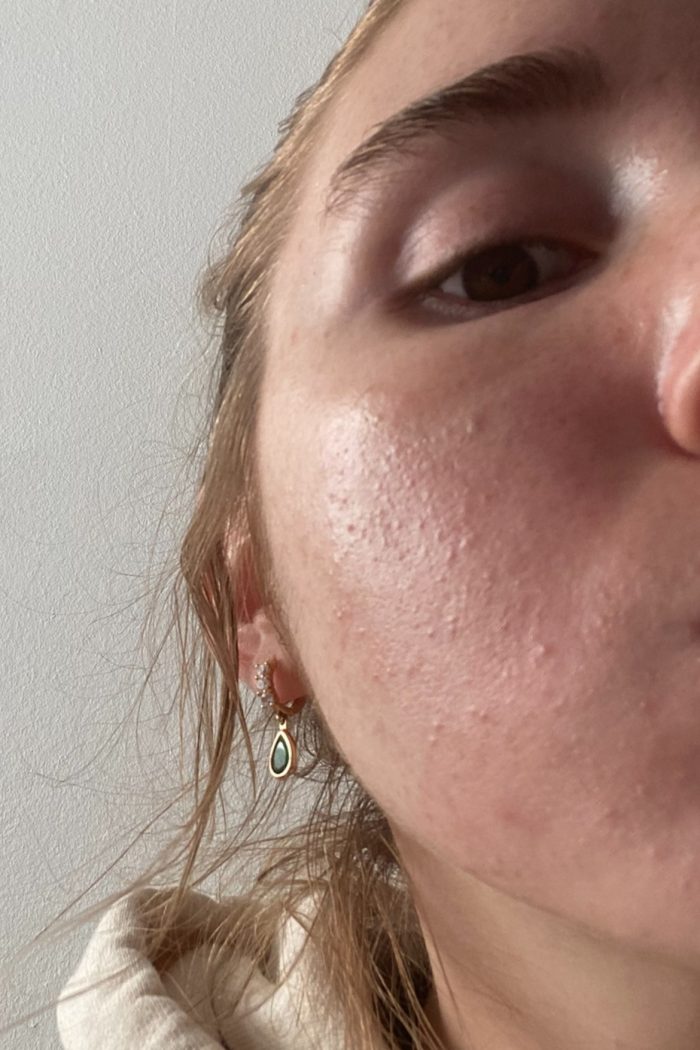 How to get rid of comedonal acne: tips for unclogging pores