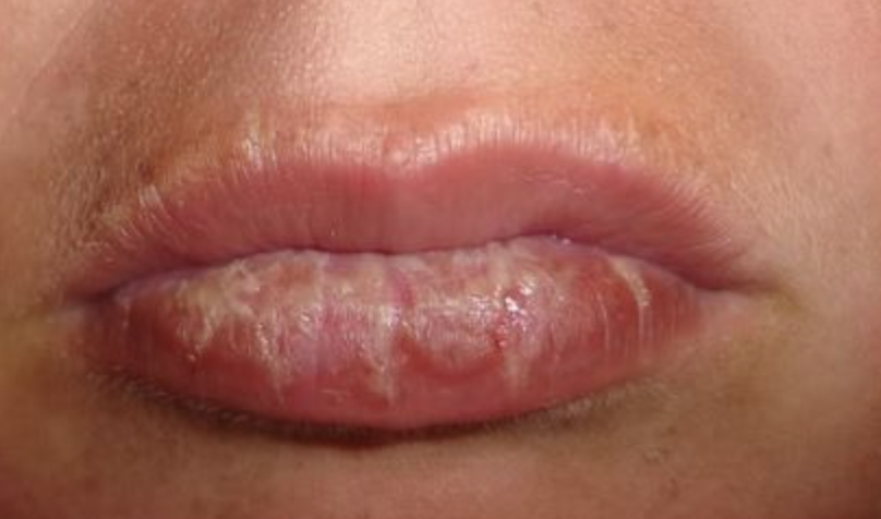 sunburned lips sunburned lips