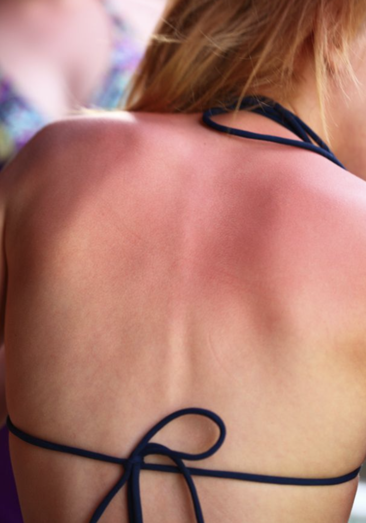 sunburn on back sunburn on back
