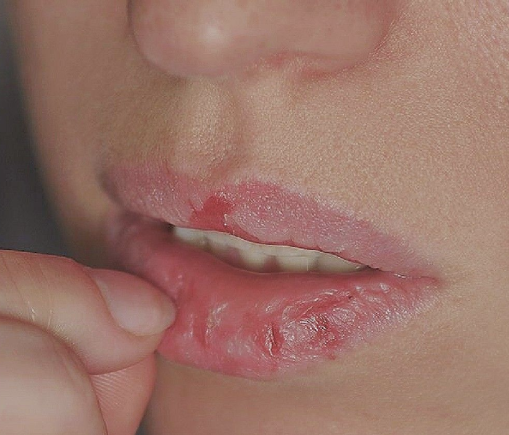 peeling dry lips What to put on sunburned lips to heal quickly