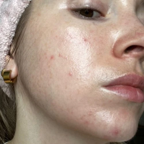 Does retinol make you break out?
