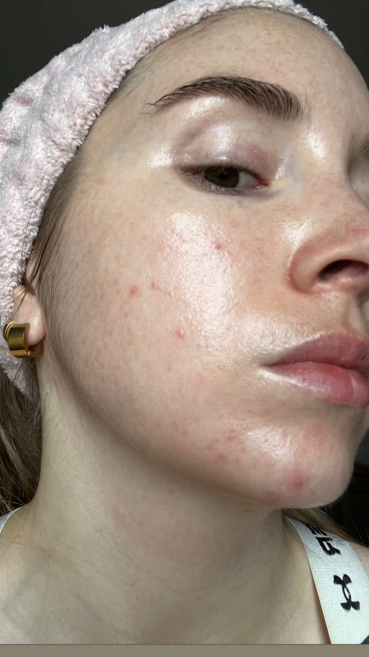 Does retinol make you break out?