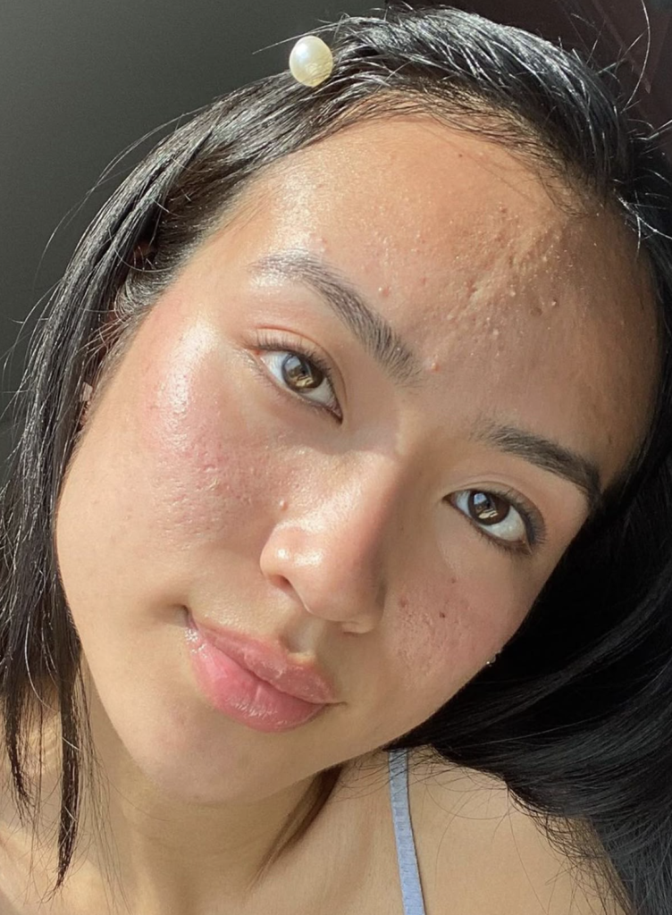What is combination skin? What is combination skin?