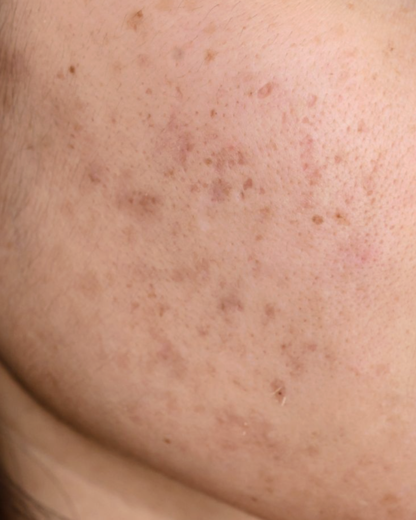 What is retinaldehyde: close-up of woman's face with unhealthy skin