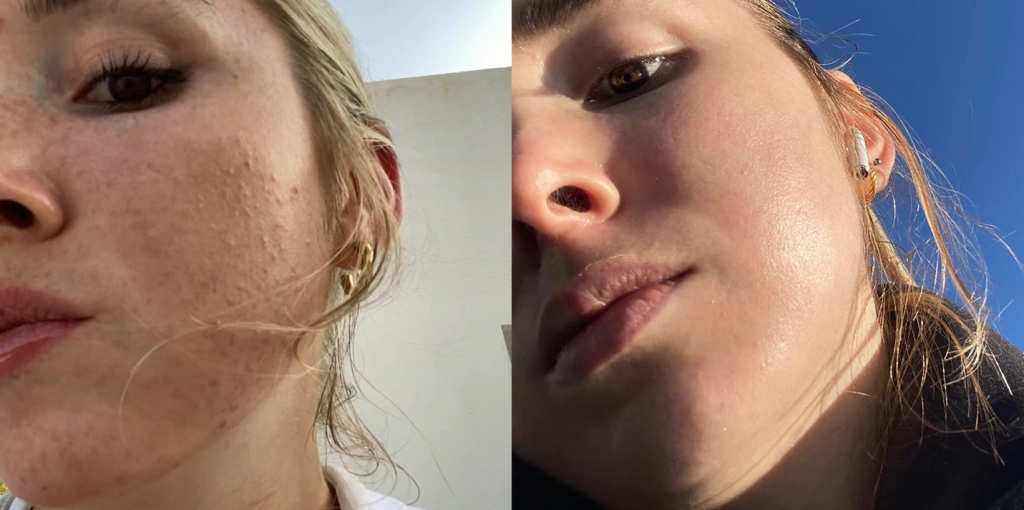 Before and after using retinaldehyde