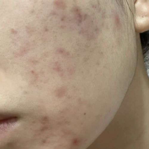 Does salicylic acid help with acne scars or just breakouts?