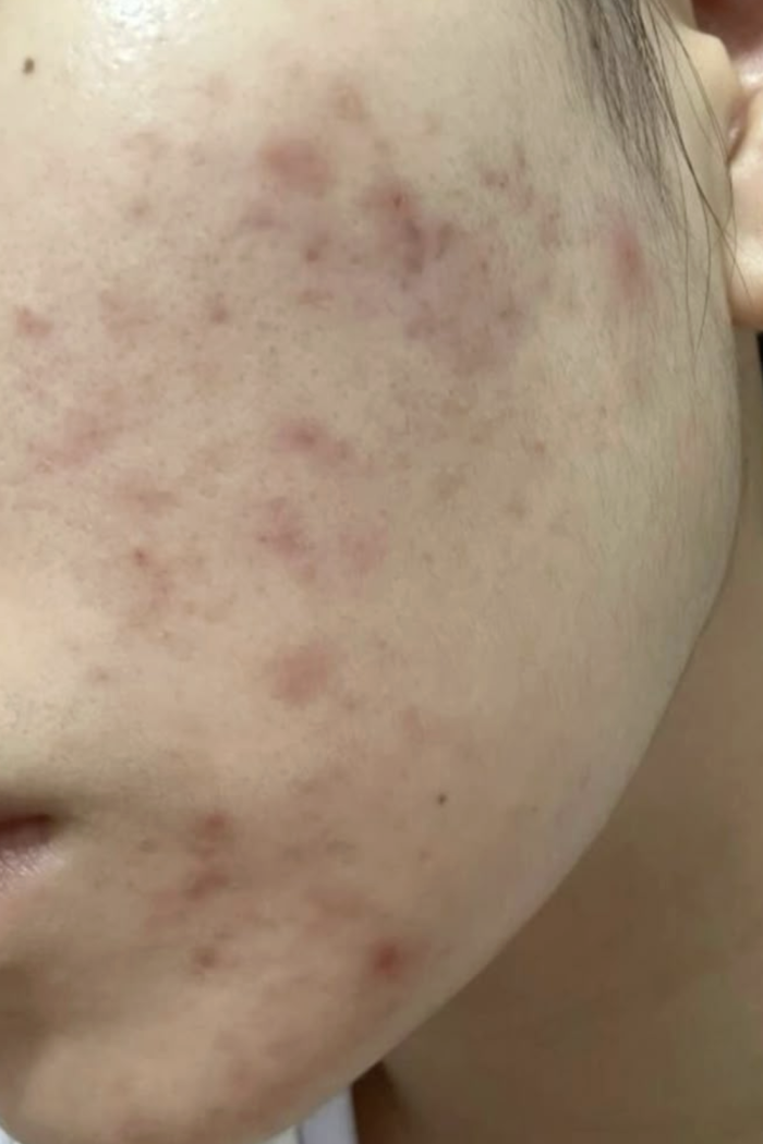 Does salicylic acid help with acne scars or just breakouts?