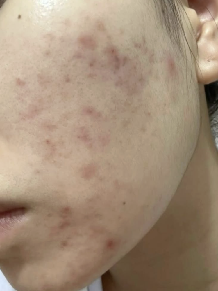 Does salicylic acid help with acne scars or just breakouts?