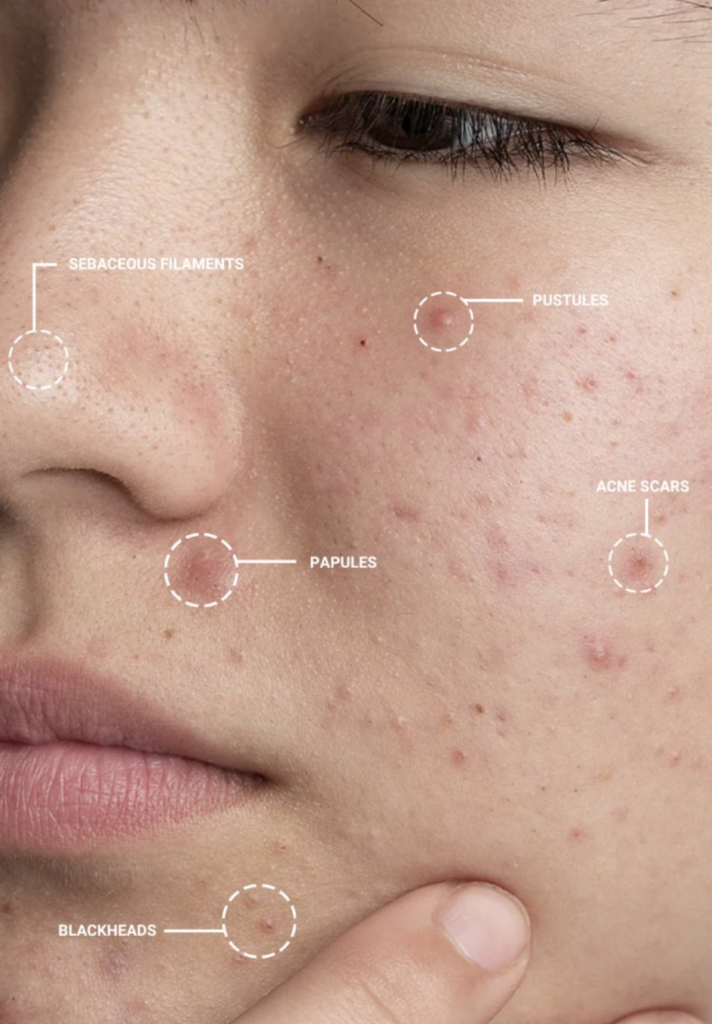 Clarifies pores and refines texture