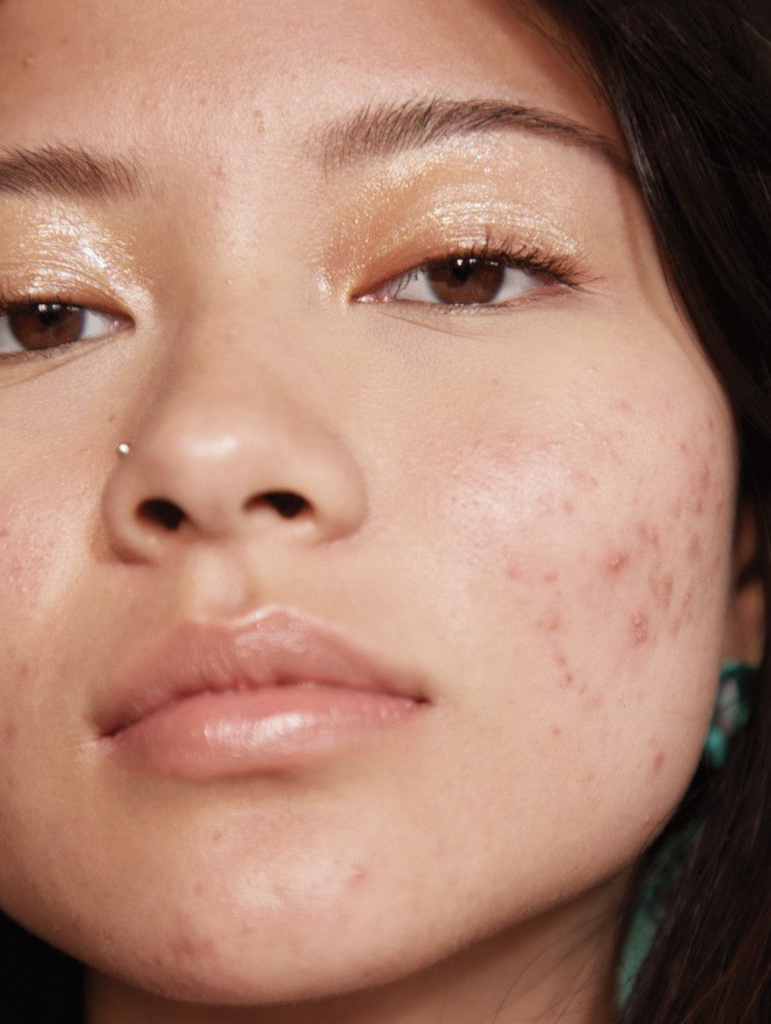 What is acne-prone skin?