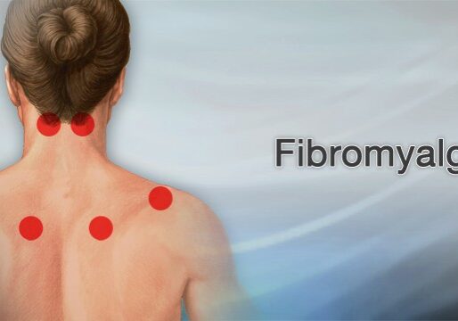 Fibromyalgia