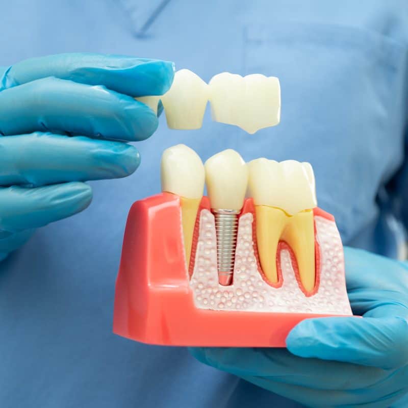Dental crown and bridge model for dental restoration education.