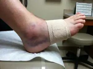 Foot injury with swelling and bruising after running exercise.