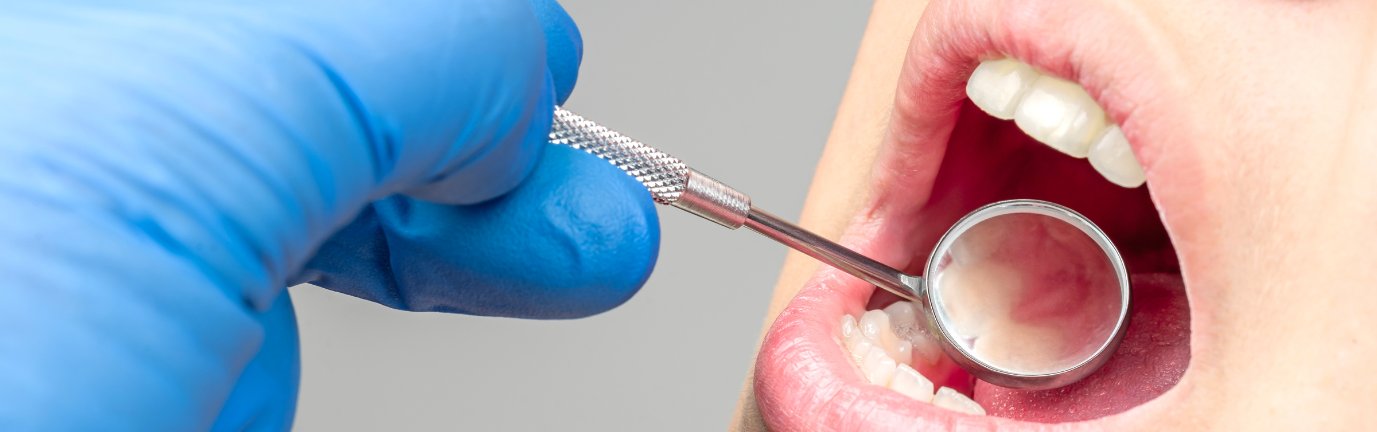 Controllo parodontale delle gengive con specchietto odontoiatrico