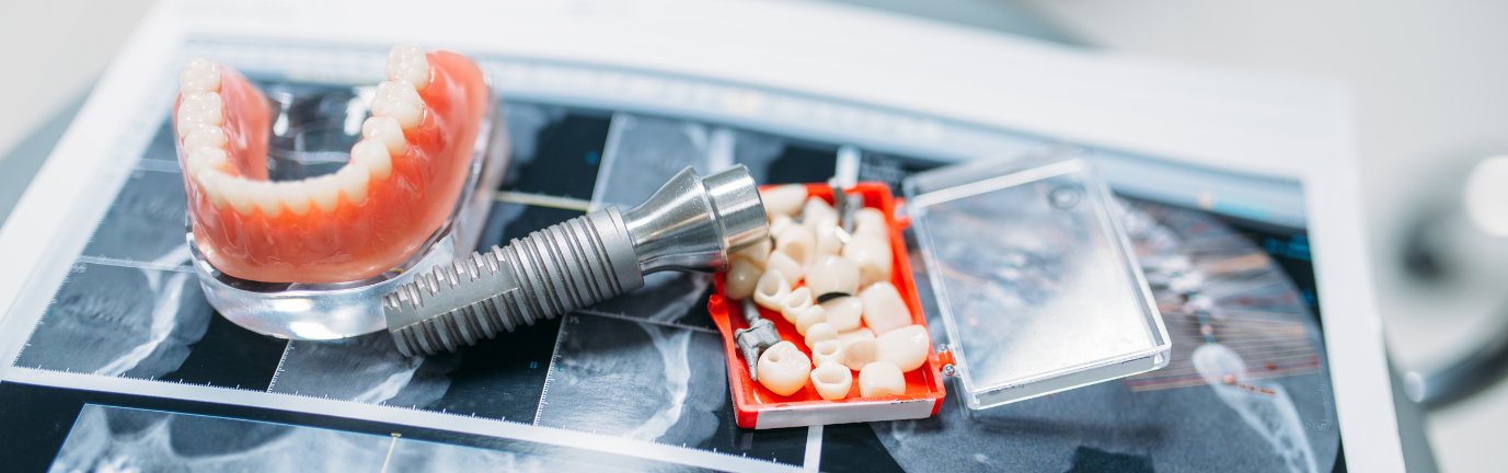 Protesi dentale e impianto su radiografia odontoiatrica