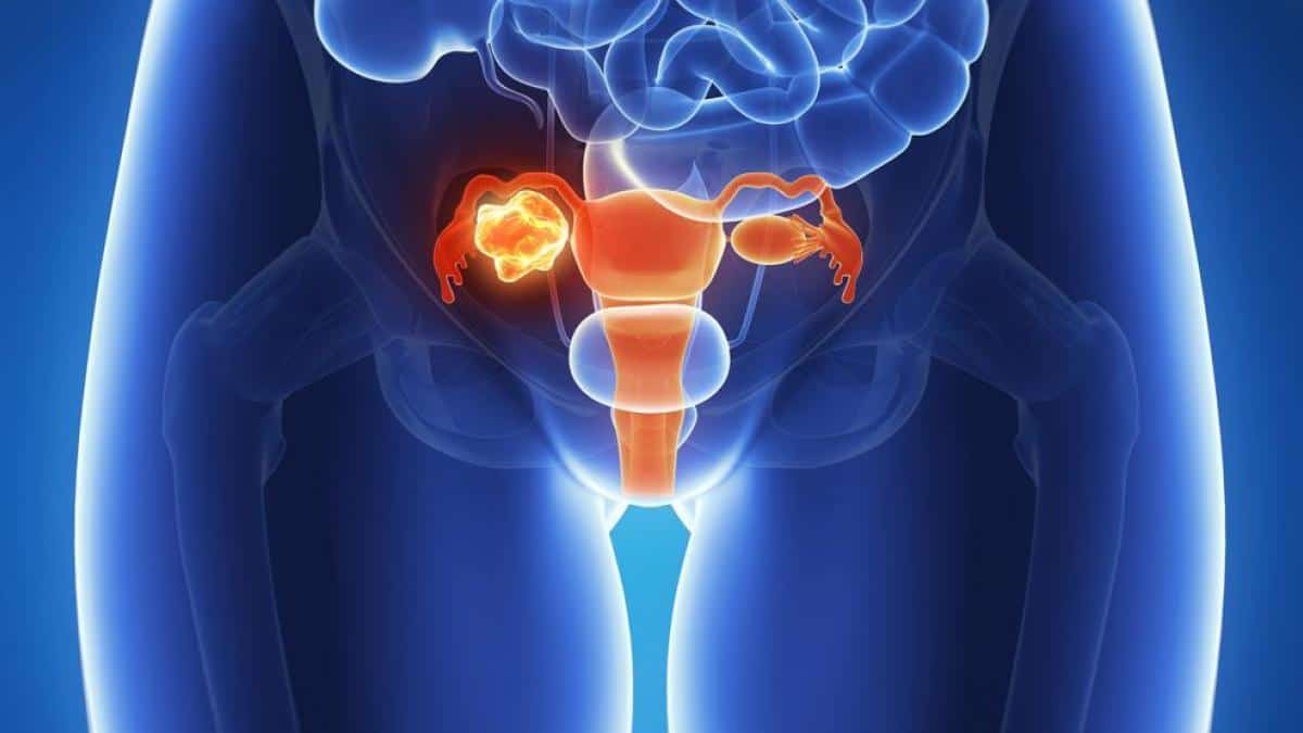 Advierten sobre la demora en el camino del diagnóstico y del tratamiento del cáncer de ovario, que condiciona el pronóstico de las pacientes