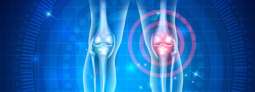 An x-ray of 2 knees illustrating arthritis in one of the knees