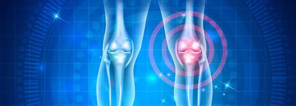 An x-ray of 2 knees illustrating arthritis in one of the knees