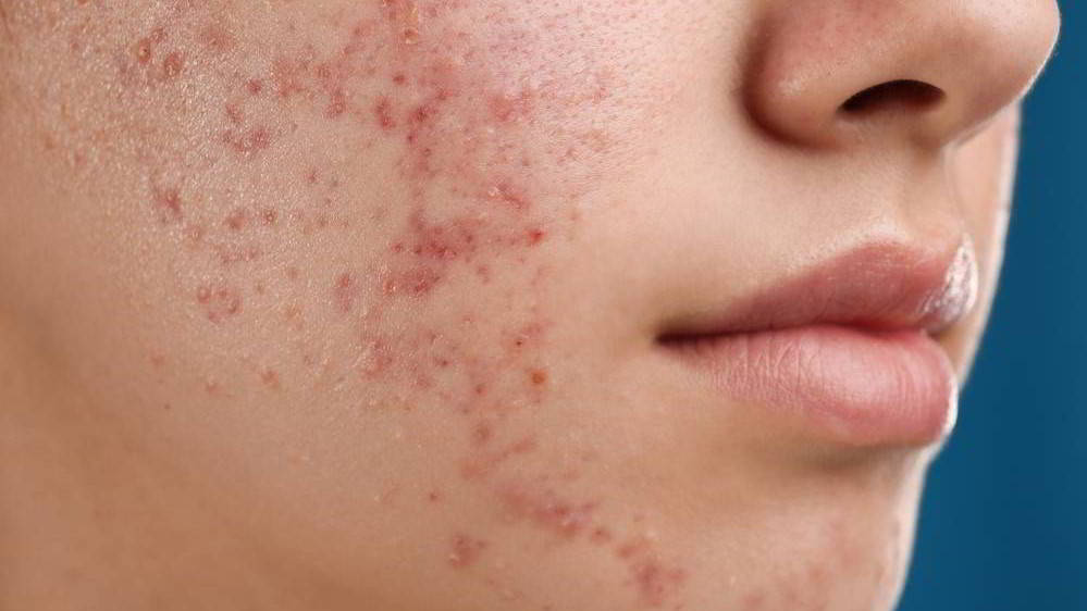 אקנה p ודלקות