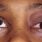 Scientists Links Disturbing Eye Condition to Covid ‘Vaccines’