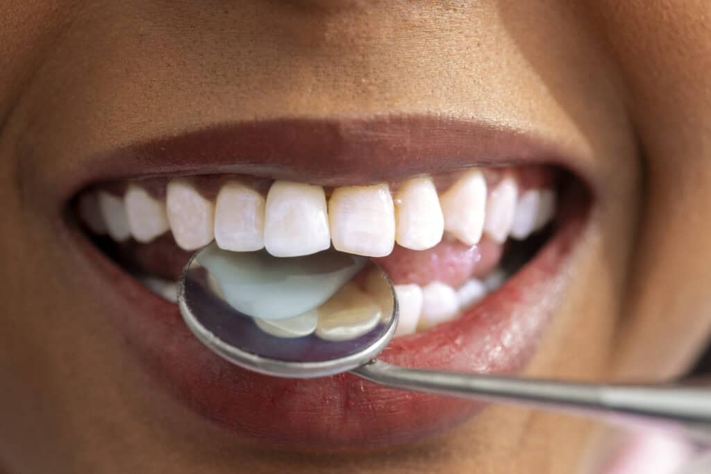 Tooth-colored fillings in Smiths Grove Family Dentistry restore decayed teeth with natural-looking c.